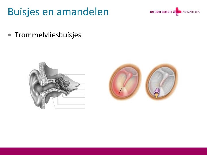 Buisjes en amandelen • Trommelvliesbuisjes 