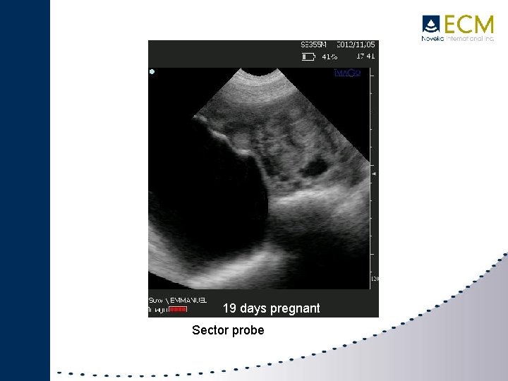 19 days pregnant Sector probe 