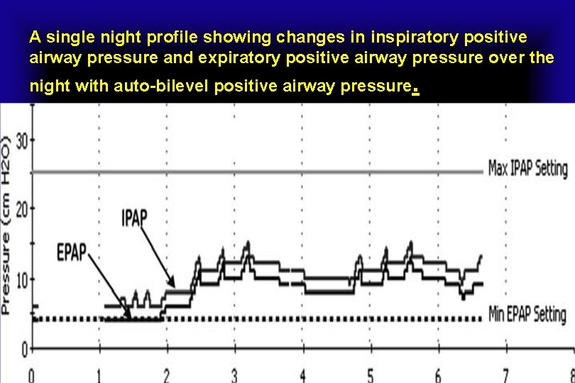 A single night profile showing changes in inspiratory positive airway pressure and expiratory positive