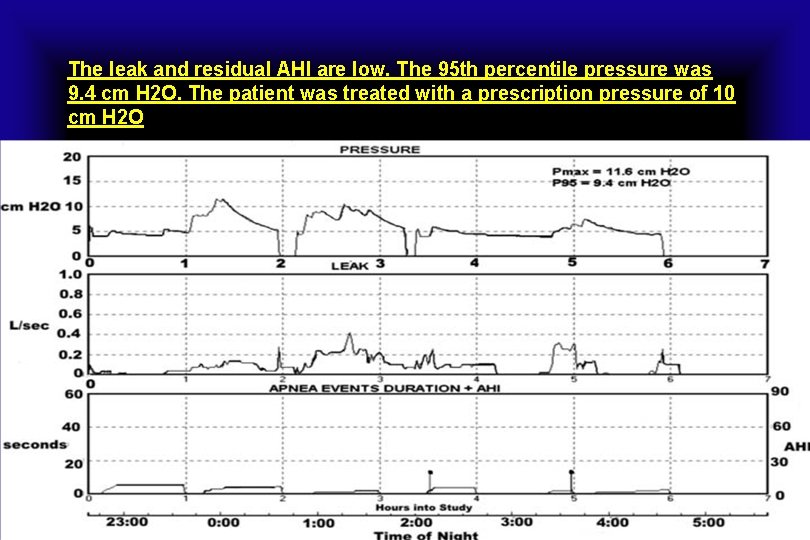 The leak and residual AHI are low. The 95 th percentile pressure was 9.