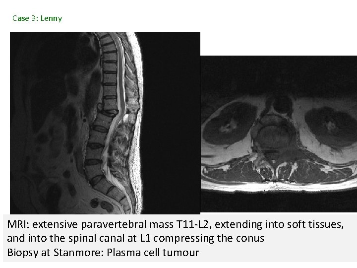 Case 3: Lenny MRI: extensive paravertebral mass T 11 -L 2, extending into soft