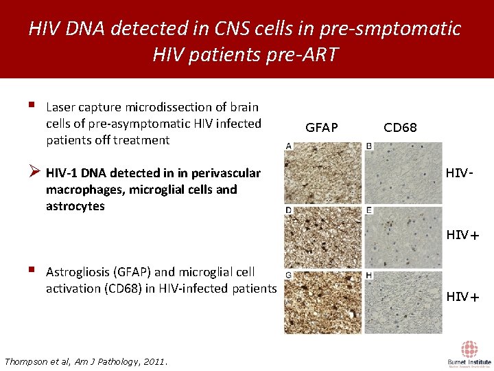 HIV DNA detected in CNS cells in pre-smptomatic HIV patients pre-ART § Laser capture