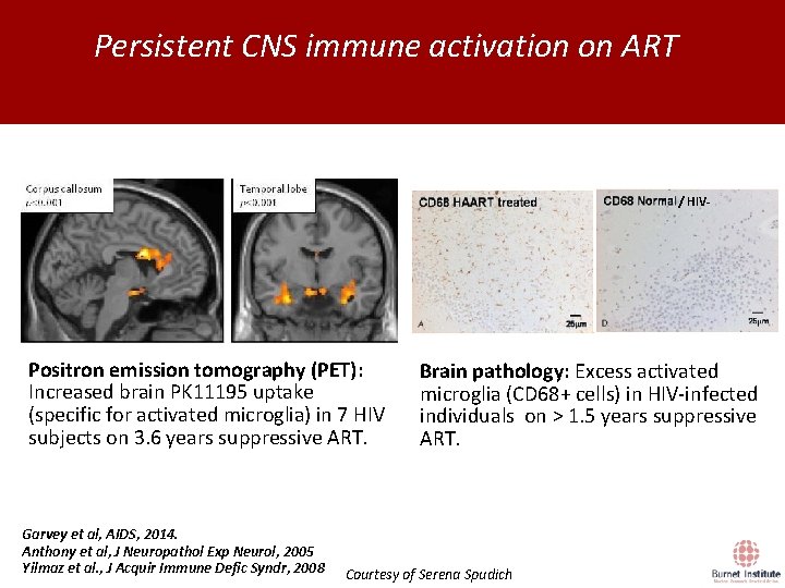 Persistent CNS immune activation on ART / HIV- Positron emission tomography (PET): Increased brain