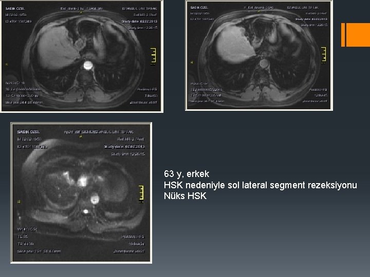 63 y, erkek HSK nedeniyle sol lateral segment rezeksiyonu Nüks HSK 