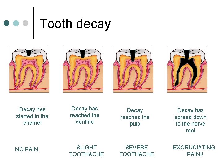 Tooth decay Decay has started in the enamel Decay has reached the dentine Decay