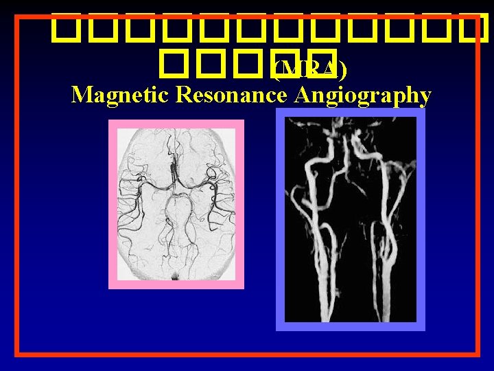 ������� (MRA) Magnetic Resonance Angiography 