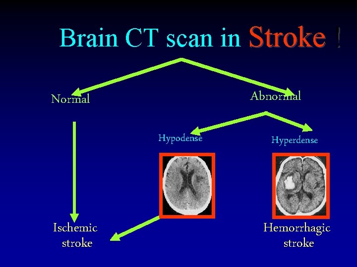 Brain CT scan in Stroke ! Abnormal Normal Hypodense Ischemic stroke Hyperdense Hemorrhagic stroke