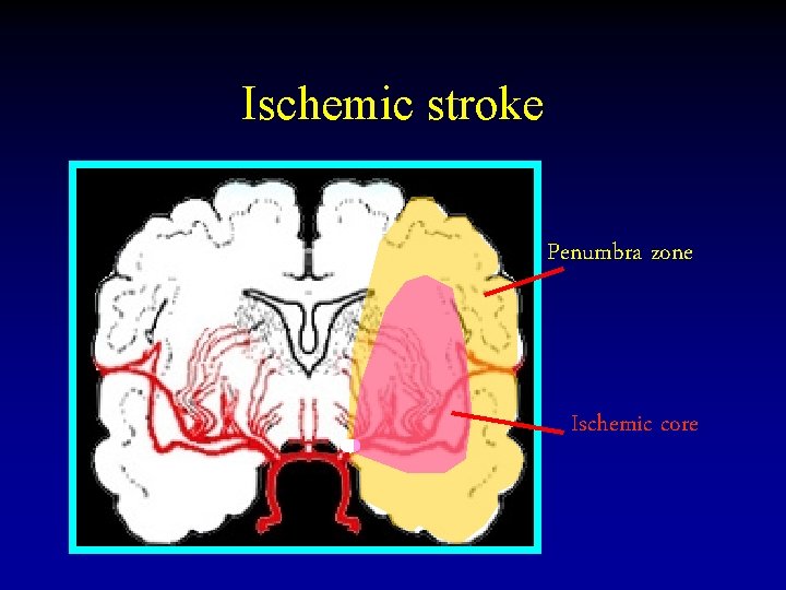 Ischemic stroke Penumbra zone Ischemic core 