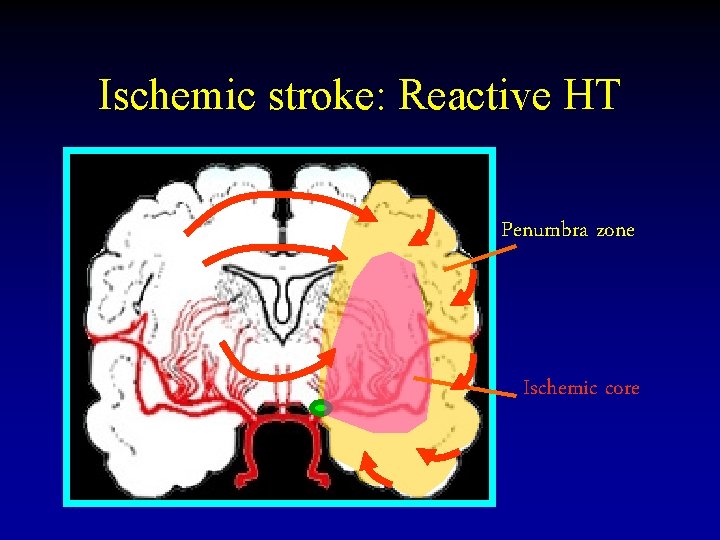 Ischemic stroke: Reactive HT Penumbra zone Ischemic core 