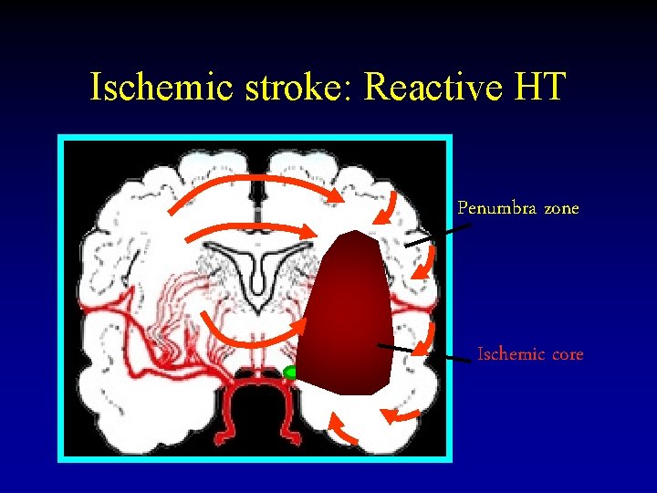 Ischemic stroke: Reactive HT Penumbra zone Ischemic core 