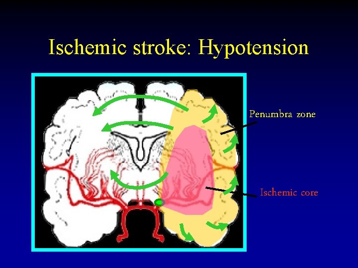 Ischemic stroke: Hypotension Penumbra zone Ischemic core 