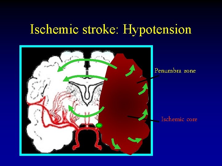 Ischemic stroke: Hypotension Penumbra zone Ischemic core 