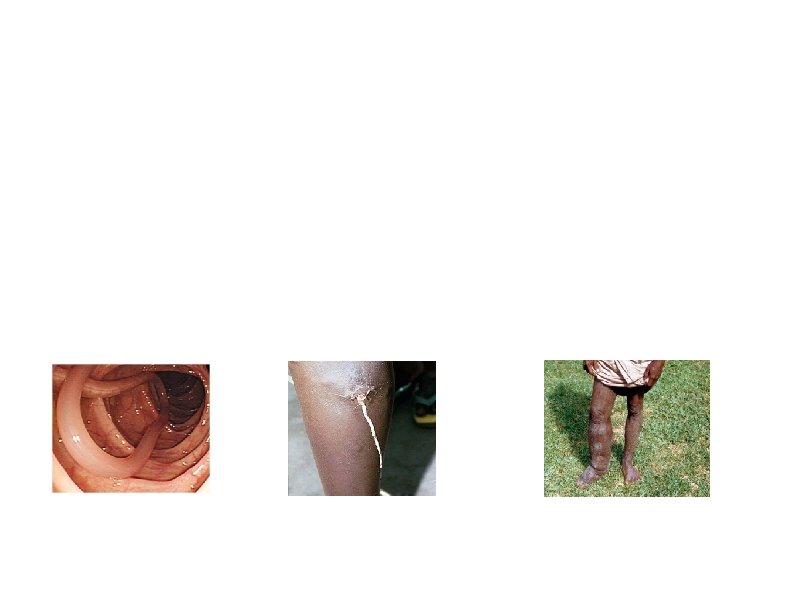 Diseases Continued a. Trichinosis a. Symptoms: diarrhea, high fever, muscle pain, sensitivity to light,