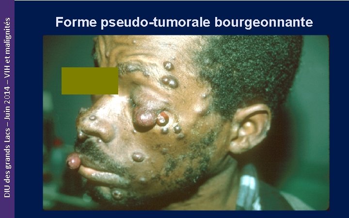 DIU des grands Lacs – Juin 2014 – VIH et malignités Forme pseudo-tumorale bourgeonnante