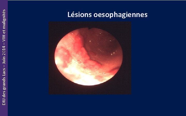 DIU des grands Lacs – Juin 2014 – VIH et malignités Lésions oesophagiennes 