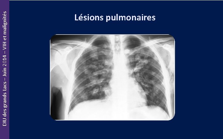 DIU des grands Lacs – Juin 2014 – VIH et malignités Lésions pulmonaires 