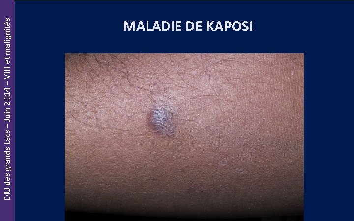 DIU des grands Lacs – Juin 2014 – VIH et malignités MALADIE DE KAPOSI