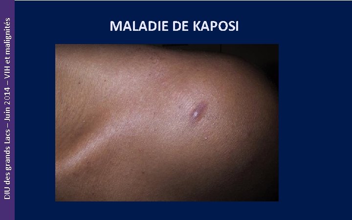 DIU des grands Lacs – Juin 2014 – VIH et malignités MALADIE DE KAPOSI