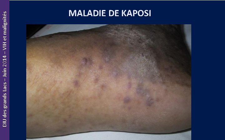 DIU des grands Lacs – Juin 2014 – VIH et malignités MALADIE DE KAPOSI