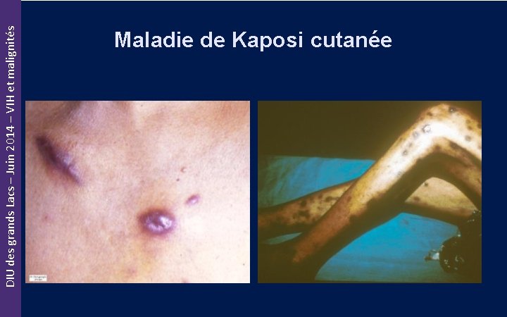 DIU des grands Lacs – Juin 2014 – VIH et malignités Maladie de Kaposi