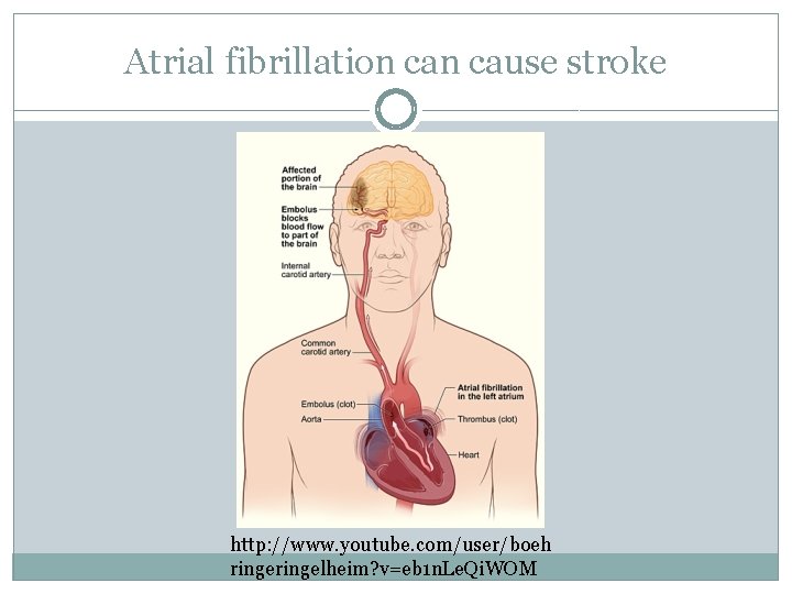 Atrial fibrillation cause stroke http: //www. youtube. com/user/boeh ringelheim? v=eb 1 n. Le. Qi.