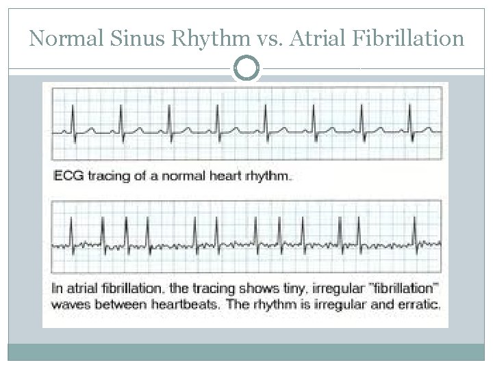 Normal Sinus Rhythm vs. Atrial Fibrillation 