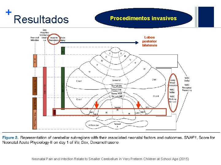 + Resultados Procedimentos invasivos Lobos posterior bilaterais Neonatal Pain and Infection Relate to Smaller