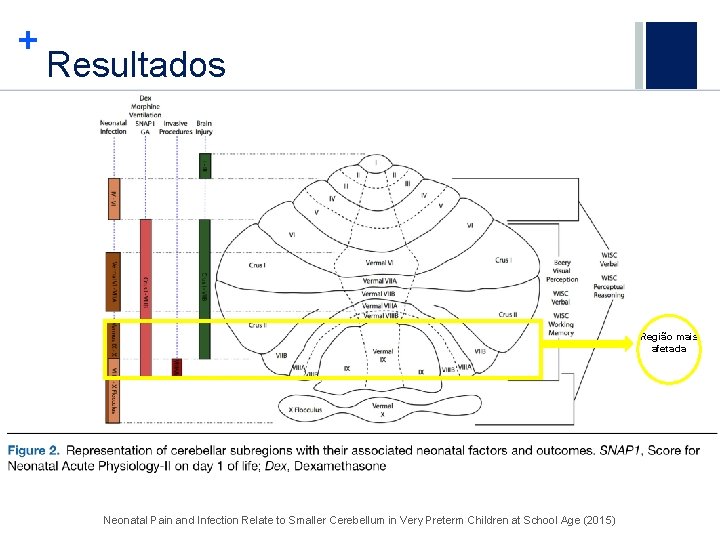 + Resultados Região mais afetada Neonatal Pain and Infection Relate to Smaller Cerebellum in