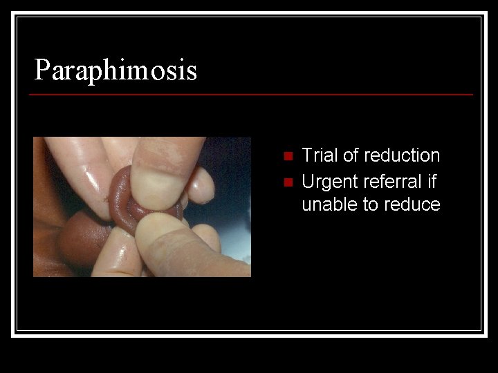 Paraphimosis n n Trial of reduction Urgent referral if unable to reduce 