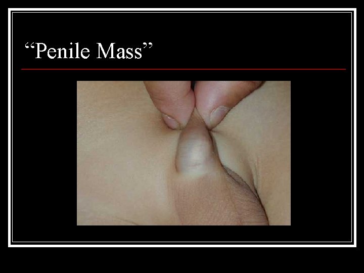 “Penile Mass” 