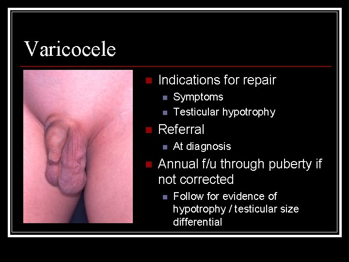 Varicocele n Indications for repair n n n Referral n n Symptoms Testicular hypotrophy