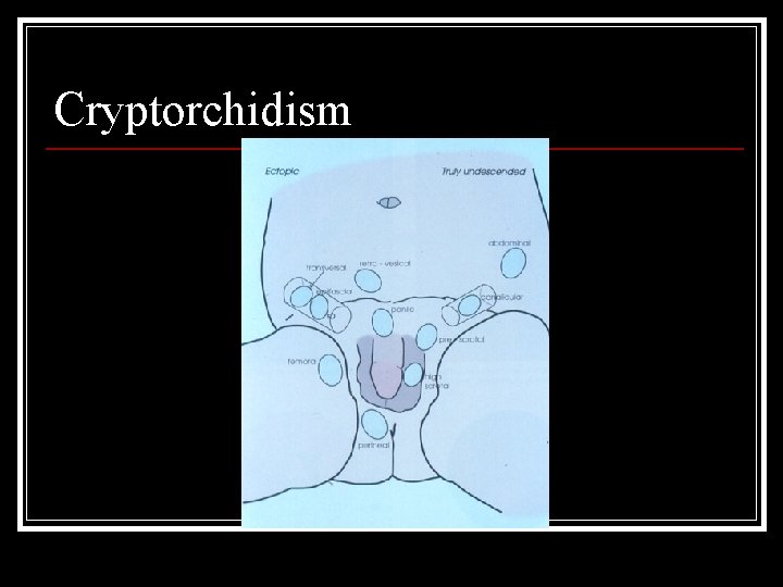 Cryptorchidism 