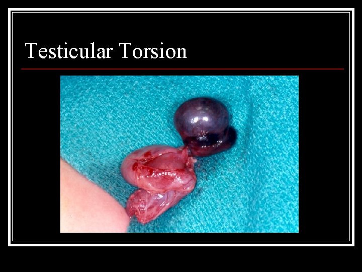 Testicular Torsion 