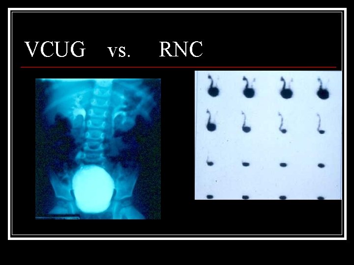 VCUG vs. RNC 