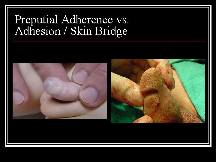 Preputial Adherence vs. Adhesion / Skin Bridge 
