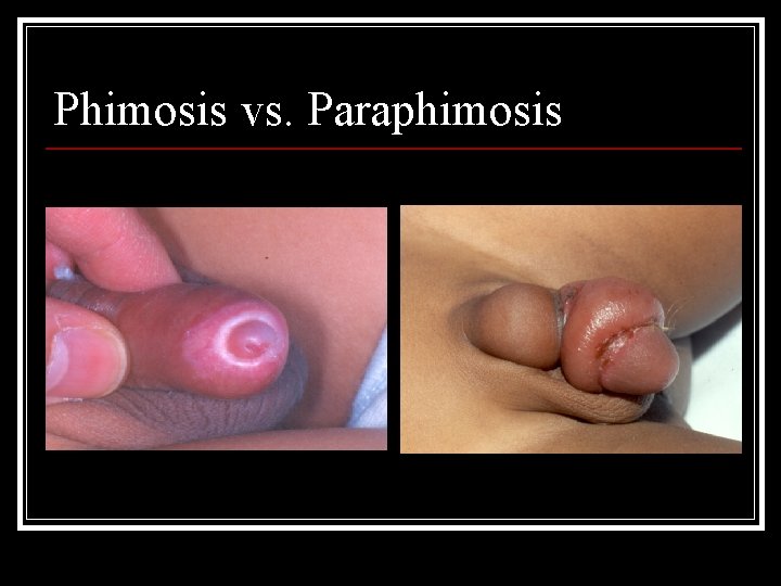Phimosis vs. Paraphimosis 