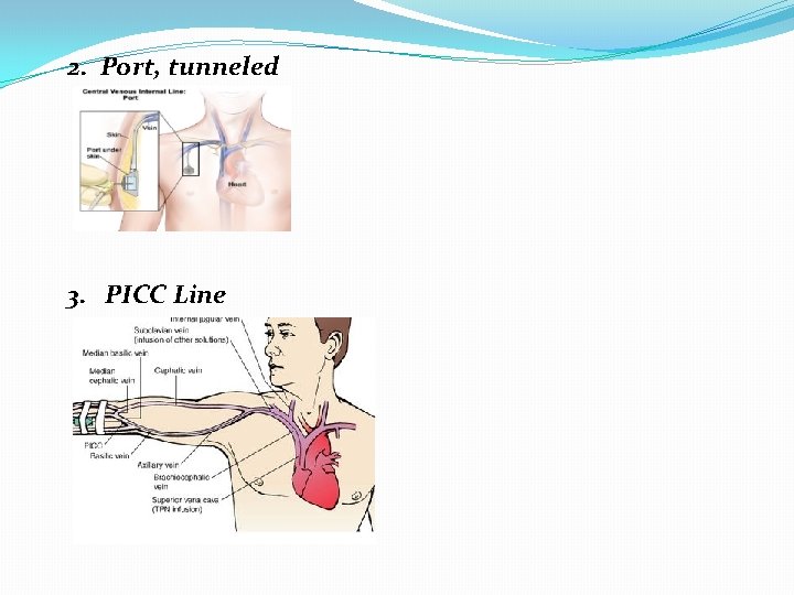 2. Port, tunneled 3. PICC Line 