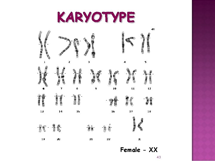 KARYOTYPE Female - XX 43 