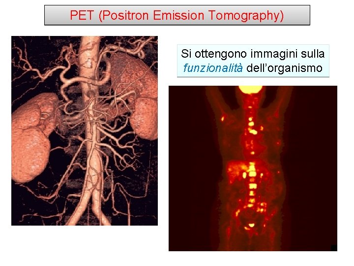 PET (Positron Emission Tomography) Si ottengono immagini sulla funzionalità dell’organismo 