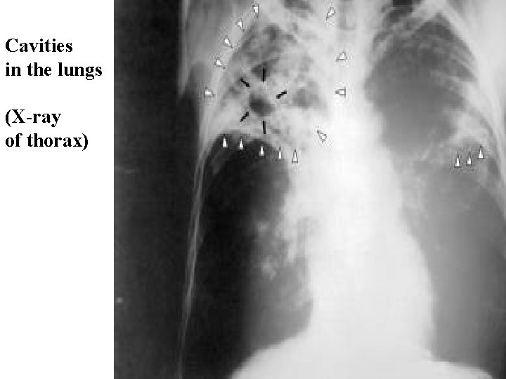 Cavities in the lungs (X-ray of thorax) 