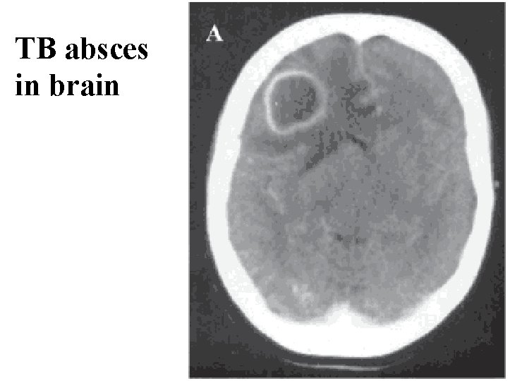 TB absces in brain 