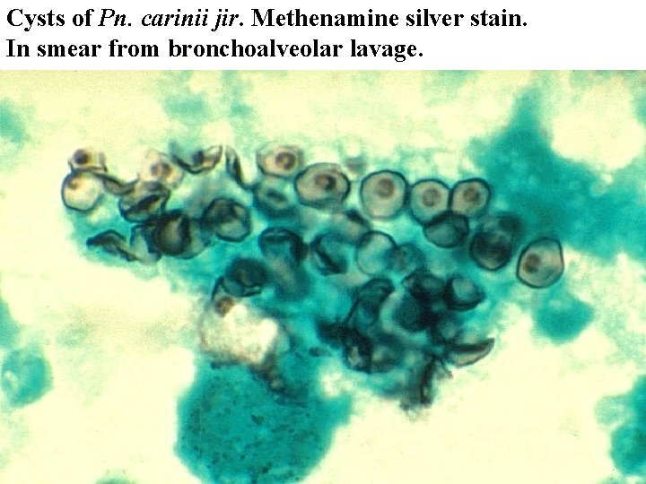 Cysts of Pn. carinii jir. Methenamine silver stain. In smear from bronchoalveolar lavage. 