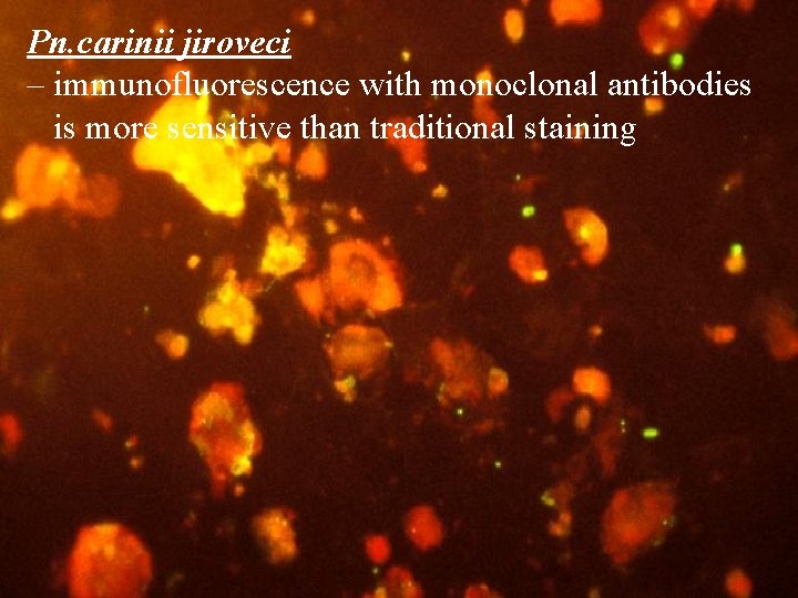 Pn. carinii jiroveci – immunofluorescence with monoclonal antibodies is more sensitive than traditional staining