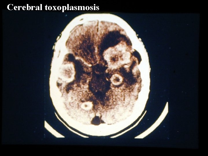 Cerebral toxoplasmosis 