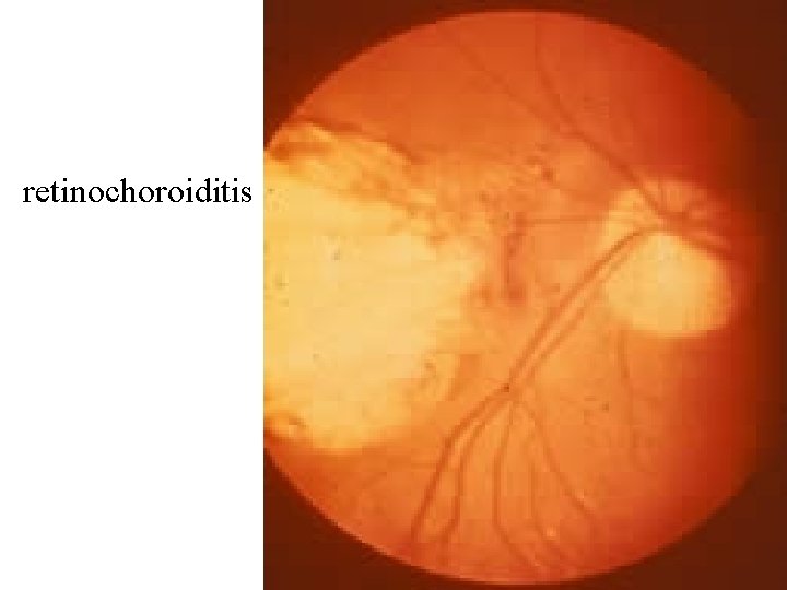 retinochoroiditis 