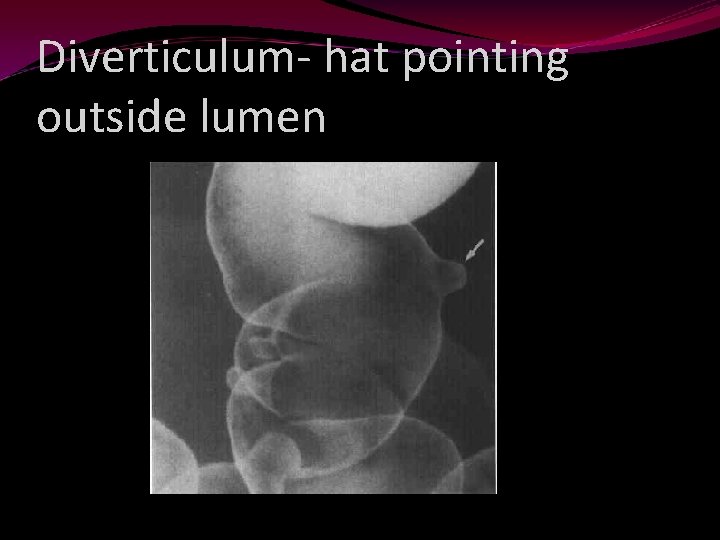 Diverticulum- hat pointing outside lumen 