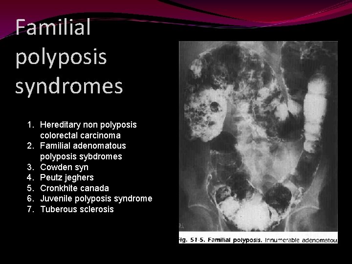 Familial polyposis syndromes 1. Hereditary non polyposis colorectal carcinoma 2. Familial adenomatous polyposis sybdromes