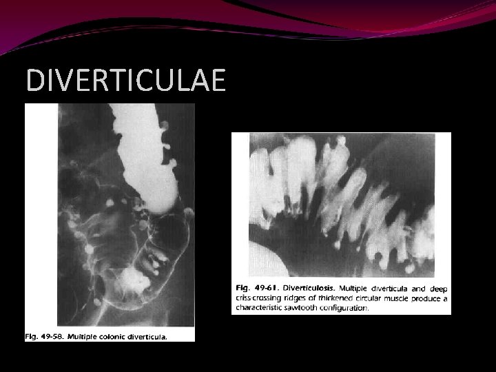DIVERTICULAE 