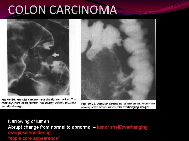 COLON CARCINOMA Narrowing of lumen Abrupt change from normal to abnormal – tumor shelf/overhanging