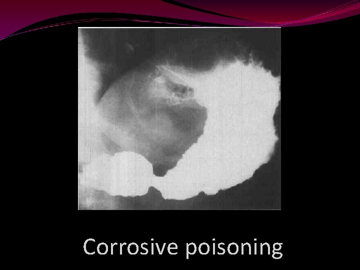 Corrosive poisoning 